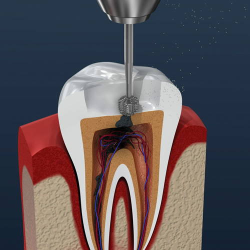 endodoncia.jpg